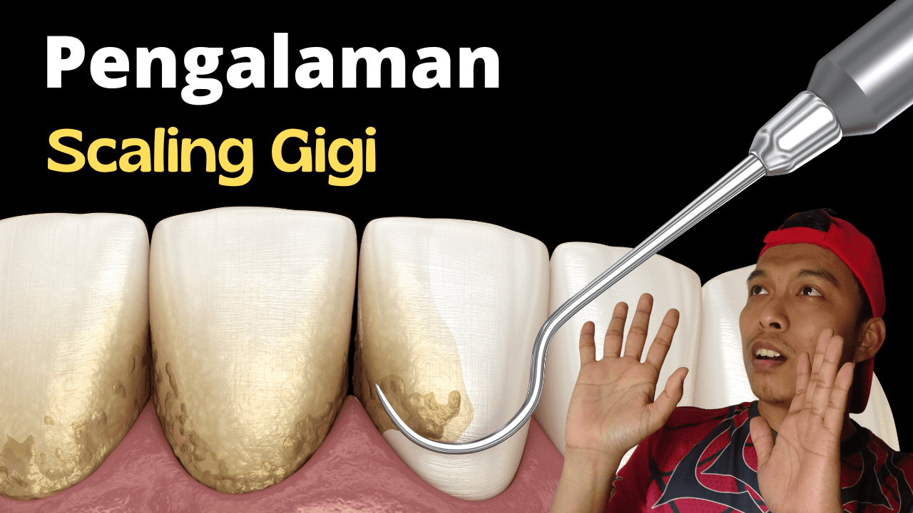 Pengalaman Pertama Aku Scaling Gigi. Sakit Ke?