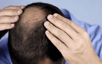 Cara Merawat Rambut Gugur Supaya Rambut Sihat Dan Lebat